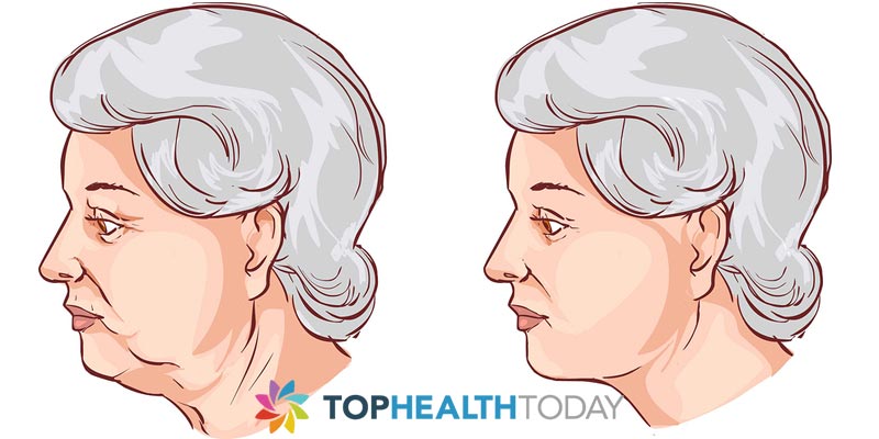 Advantages and Disadvantages of Neck Lifts