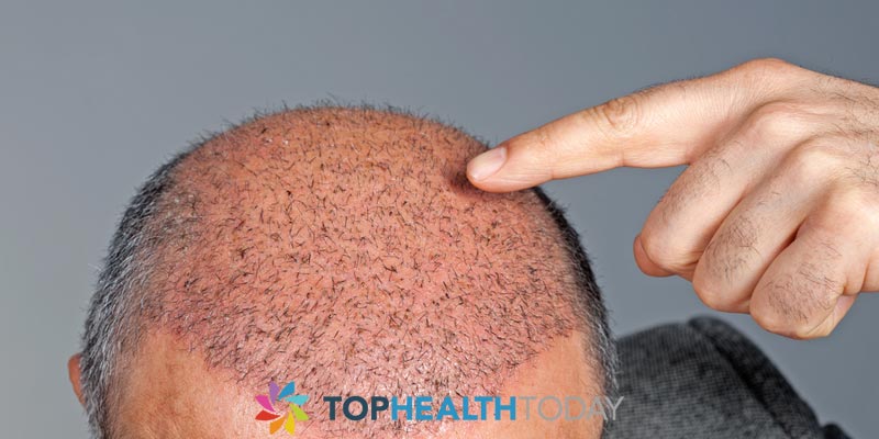 Are Hair Transplants Safe?