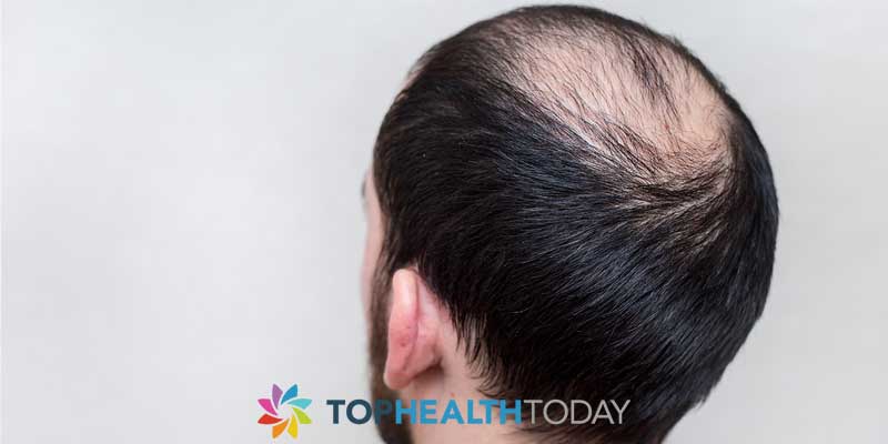 DHT-The-Main-Component-of-Male-Hair-Loss